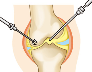 関節鏡視下手術