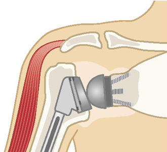 リバース型人工肩関節置換術