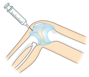 膝へのヒアルロン酸注射