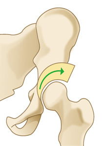 股関節の骨切り術