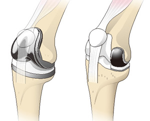 人工膝関節全置換術（左）と部分置換術（右）