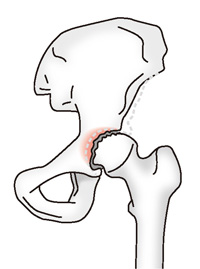 変形性股関節症