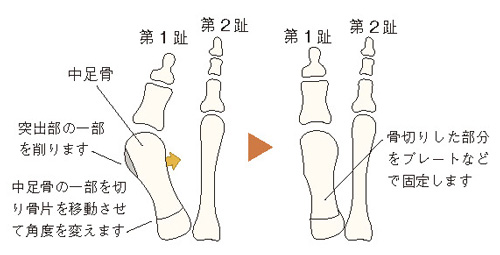 骨切り術のイメージ