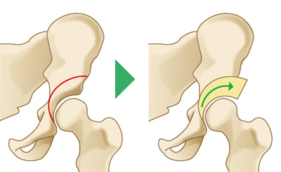 寛骨臼回転骨切り術