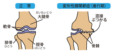 正常な膝と変形性膝関節症（進行期）