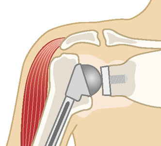 従来の人工肩関節置換術