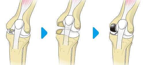 人工膝関節部分置換術の流れ