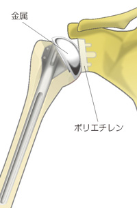 従来の人工肩関節