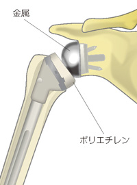 リバース型人工肩関節