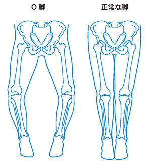 O脚と正常な脚