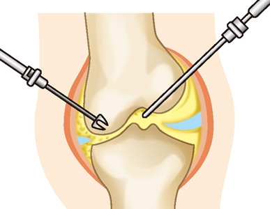 関節鏡視下手術