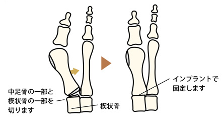 重度に対する手術の一例