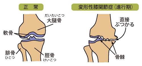 正常な膝と変形性膝関節症（進行期）