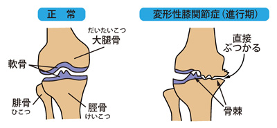 正常な膝と変形性膝関節症（進行期）