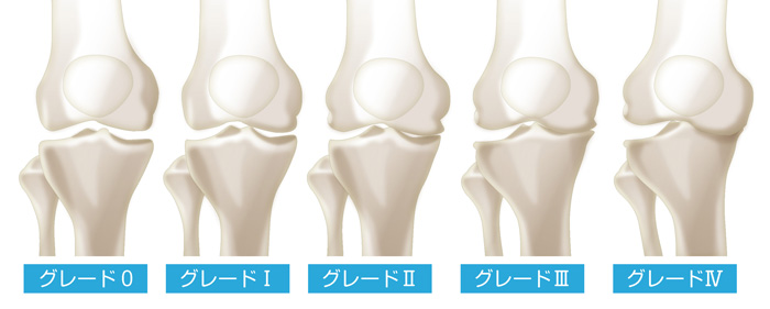 変形性膝関節症のKL分類