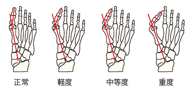 外反母趾の重症度