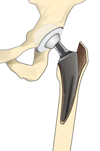 人工股関節置換術