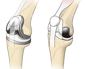 人工膝関節全置換術（左）と部分置換術（右）