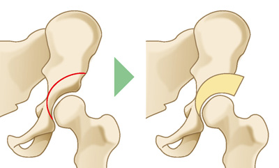 寛骨臼回転骨切り術