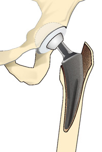 人工股関節置換術
