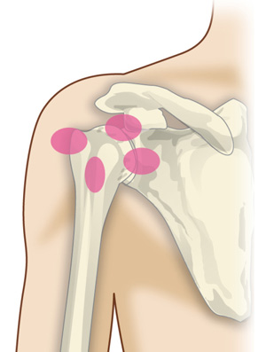 凍結肩の炎症部位