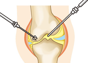 関節鏡視下手術