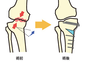 高位脛骨骨切り術