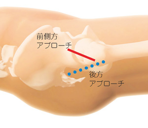 前側方アプローチと後方アプローチ