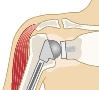 全人工肩関節