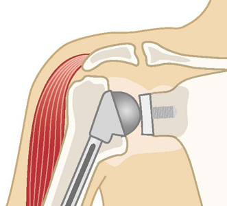 従来の人工肩関節