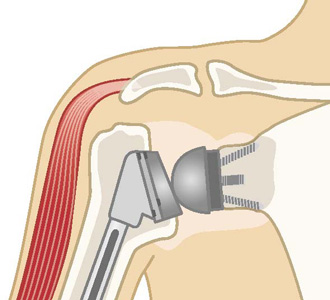 リバース型人工肩関節