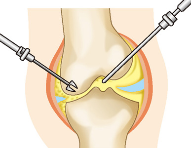 関節鏡視下手術