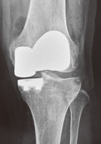 部分置換術のレントゲン