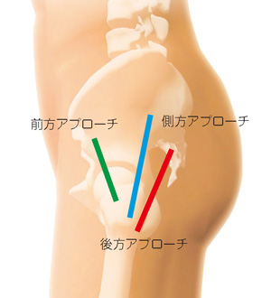 手術のアプローチ方法