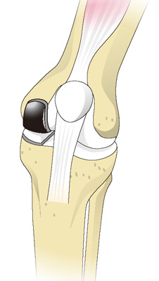 人工膝関節部分置換術