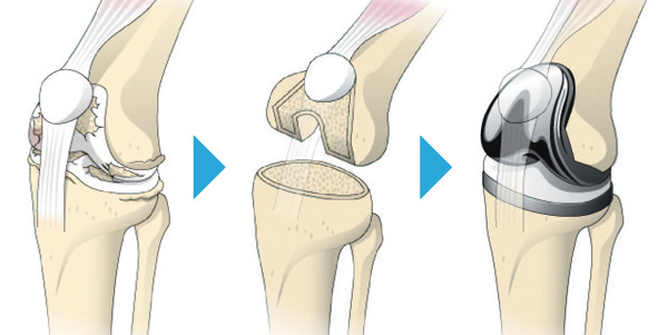 人工膝関節全置換術の流れ