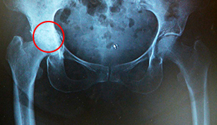 伊東 秀治 先生 まずは 痛みの原因を正しく把握することから 第45回 股関節の痛みは必ず治療できます 痛みを取り除き 機能を回復するための人工股関節 置換術 人工関節ドットコム