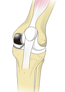 人工膝関節単顆置換術