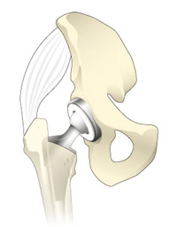 人工股関節置換術