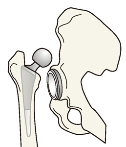 人工股関節の脱臼
