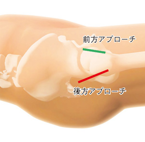 前方アプローチと後方アプローチ