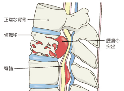 転移性脊椎腫瘍