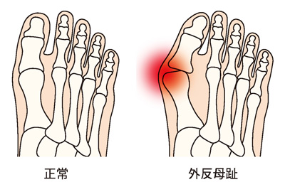 正常な足と外反母趾