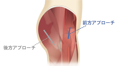 前方アプローチと後方アプローチ