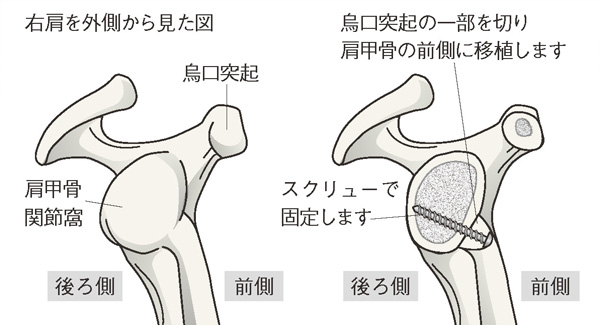 烏口突起移行法