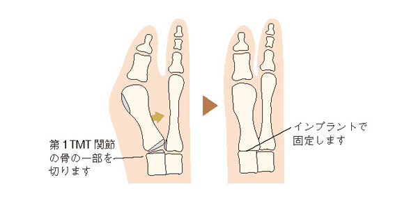 関節固定術のイメージ