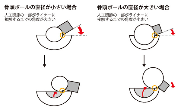 人工股関節の構造の違い