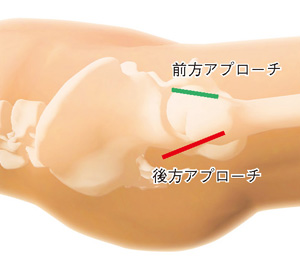 前方アプローチと後方アプローチ