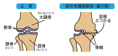 正常な膝と変形性膝関節症（進行期）