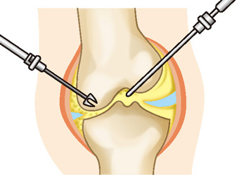 関節鏡視下手術